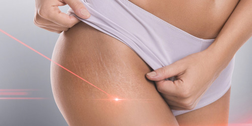 Laseroterapia